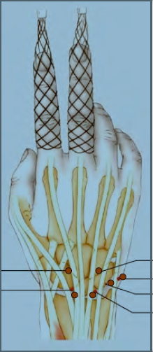 Chaussette de maintien à usage médical porté sur une main